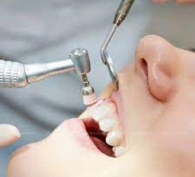 Cạo vôi răng: Những điều cần biết