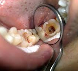 Nguyên tắc điều trị và quy trình lấy tủy răng