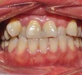 Răng khấp khểnh