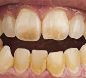 Răng ố vàng