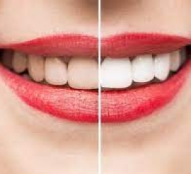 Khi nào nên tẩy trắng răng?