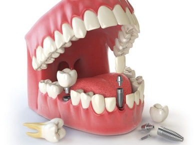 Những Điều Cần Biết Về Implant,  Cấy ghép Implant có đau không ?