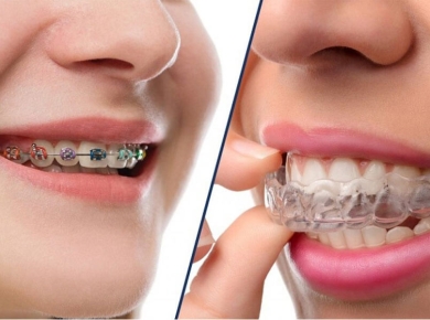  NIỀNG RĂNG CÓ TÁC DỤNG GÌ? NIỀNG RĂNG (CHỈNH NHA) LÀ GÌ?