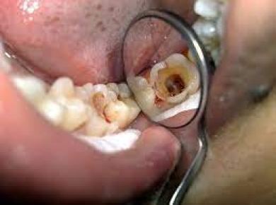 Nguyên tắc điều trị quy trình lấy tủy răng