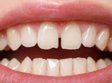 Răng thưa